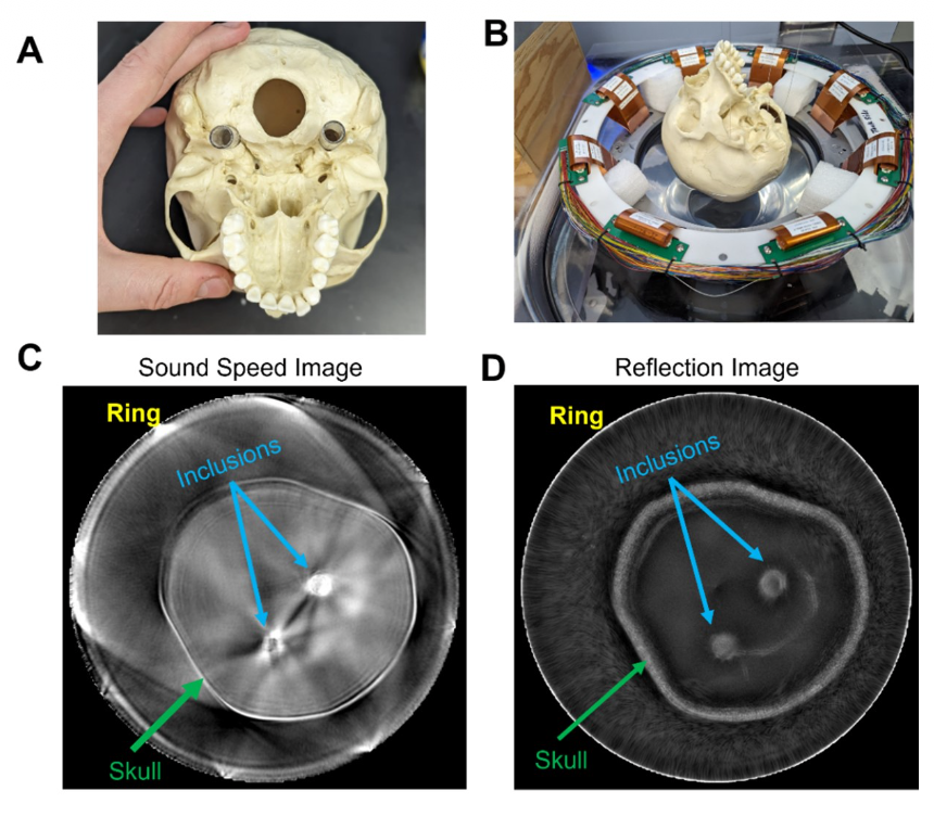 Mitcham2023IschemicStrokeThroughSkull.png